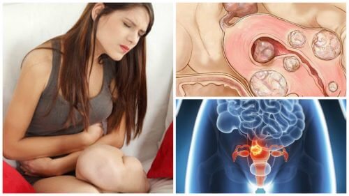 5 Dinge über Uterusmyome, die jede Frau wissen sollte