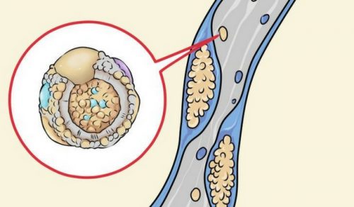 Tipps für gesunden Cholesterinspiegel