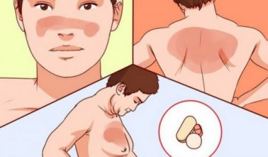 Alles, was du über Lupus wissen solltest