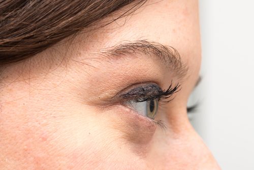 Ursachen und Behandlungsmöglichkeiten von Augenringen Ursachen und Behandlungsmöglichkeiten von Augenringen