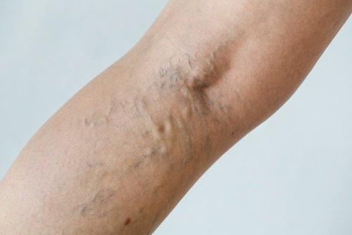 Durchblutungstörungen durch zu enge Kleidung