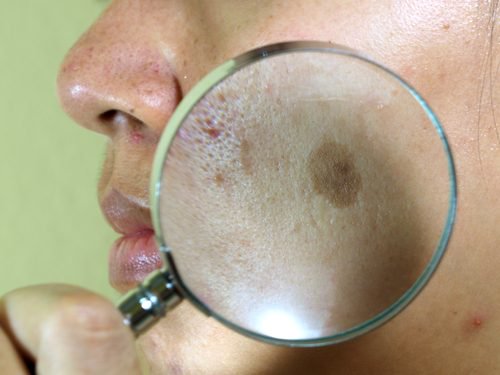 7 natürliche Behandlungen gegen den Leberfleck im Gesicht