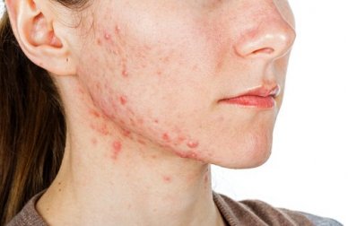 Innerliche Behandlungen zur Linderung von Akne