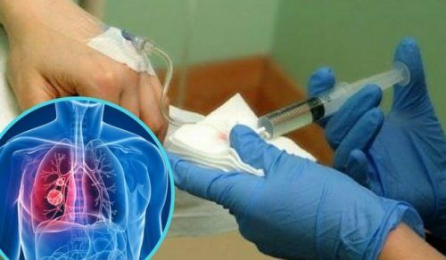 Medikament um Chemotherapie bei Lungenkrebs zu reduzieren Medikament um Chemotherapie bei Lungenkrebs zu reduzieren