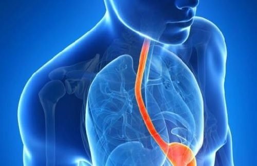 säurereflux