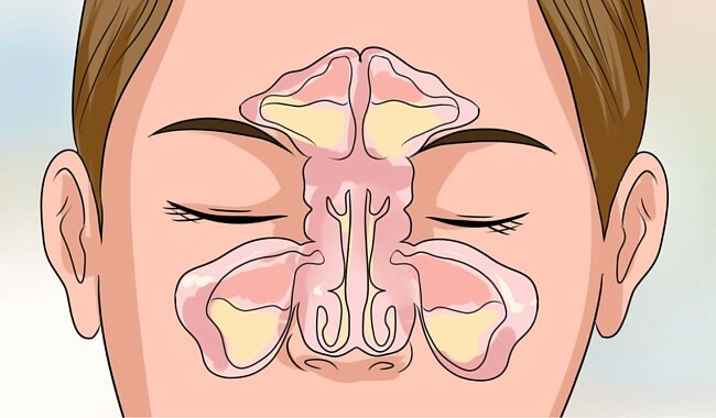 Tricks um deine Nase innerhalb von Minuten zu befreien