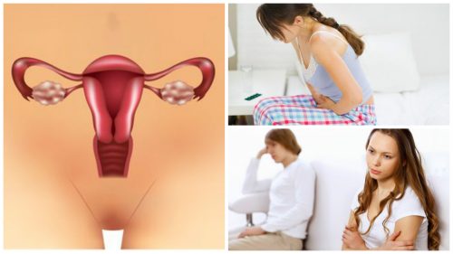 Polyzystisches Ovarialsyndrom: 7 wissenswerte Dinge Polyzystisches Ovarialsyndrom: 7 wissenswerte Dinge