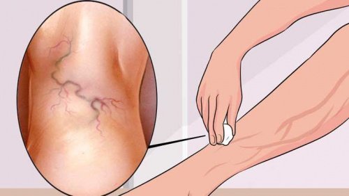 8 Übungen zur Vorbeugung von Krampfadern