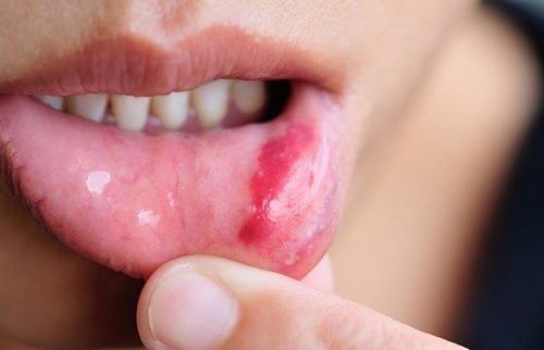 Krebs im Mund: Risikofaktoren und Symptome