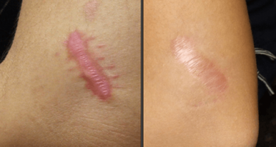 Wie kann man ein Keloid natürlich lindern?