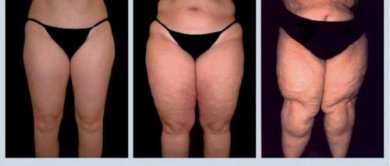 Lipödem: Ursachen und Behandlungsmöglichkeiten