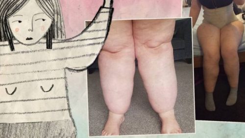 Frau mit Lipödem
