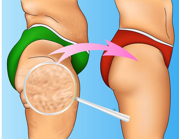 Diät, um Cellulite-Oberschenkel zu verlieren