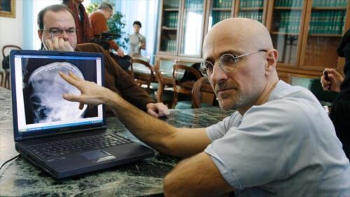 Die erste Kopftransplantation