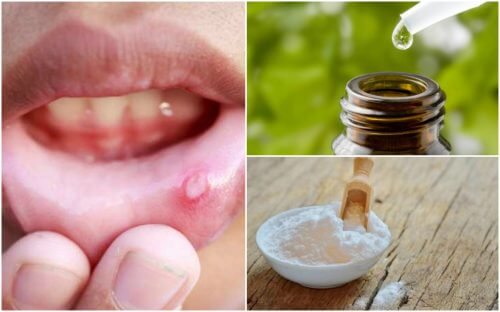 6 Naturheilmittel gegen Aphthen im Mund 6 Naturheilmittel gegen Aphthen im Mund