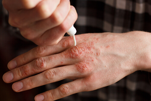 Auftragen der Salbe bei Psoriasis