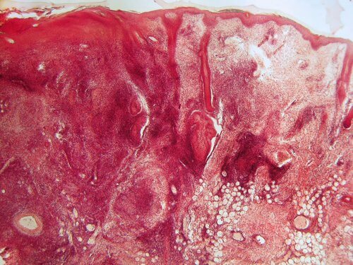 Systemischer Lupus Erythematodes ist eine Autoimmunkrankheit.