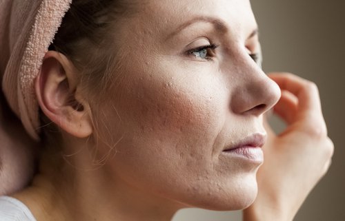 Hautbeschwerden als Anzeichen für einen hohen Cortisolspiegel