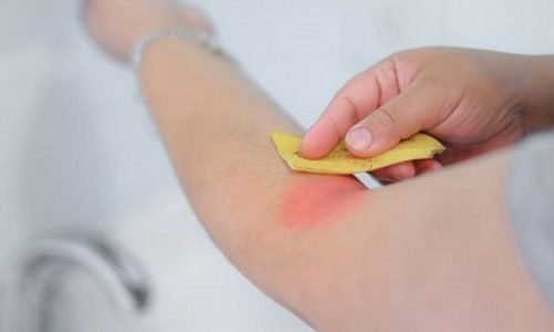 Bananenschalen verwenden um Insektenstiche zu behandeln