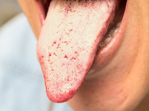 Behandlung einer Candida-Infektion