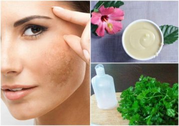 5 Tipps zur Behandlung von Pigmentflecken