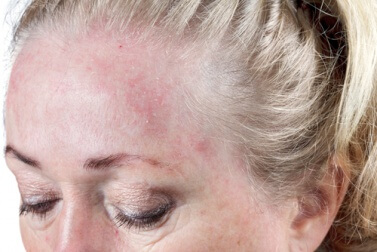 Hautinfektionen können entstehen wenn man sich mit nassen Haaren ins Bett legt