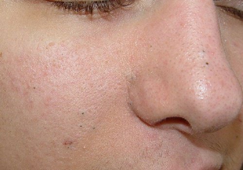 3 peelende Masken gegen Mitesser 3 peelende Masken gegen Mitesser