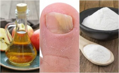 Nagelpilz natürlich behandeln mit Apfelessig und Natron