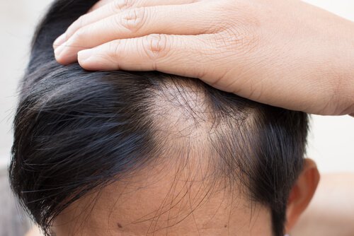 Natürliche Hilfe bei Haarausfall