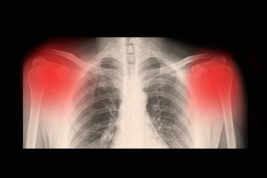 Symptome und Ursachen von Arthrose