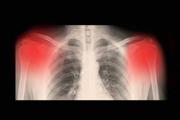 Symptome und Ursachen von Arthrose