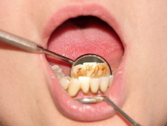 Was tun gegen Zahnstein? Tipps zur Vorsorge