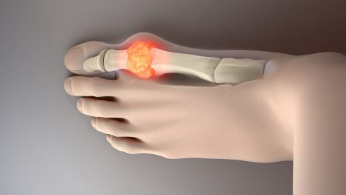 Harnsäurespiegel senken durch richtige Ernährung