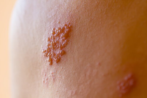 Herpes Zoster (Gürtelrose)