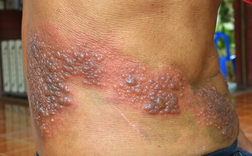 Herpes Zoster (Gürtelrose)