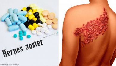 Herpes Zoster (Gürtelrose)