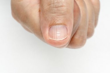 Linien auf den Nägeln und wie man sie los wird