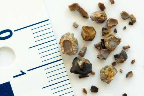 Verschieden große Nephrolithen