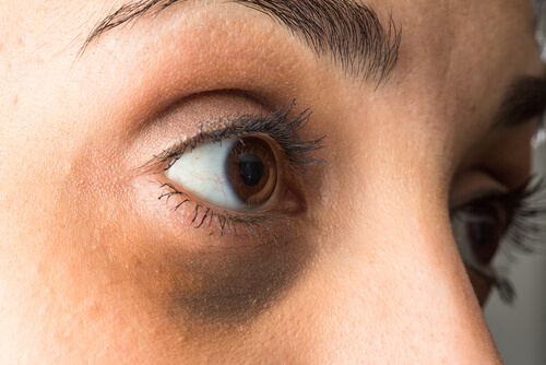 dunkle Augenringe weisen auf Hormonstörungen hin