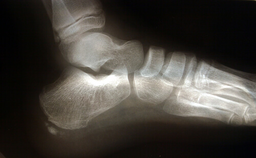 Morgens sind die Schmerzen bei einer Plantarfasziitis am schlimmsten.