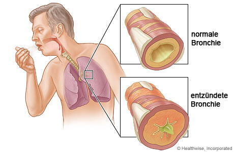 5 wirksame Mittel gegen Bronchitis - Besser Gesund Leben