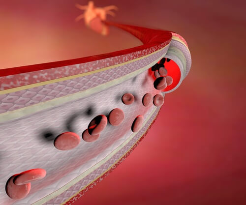 Geschwollene Knöchel als Anzeichen für verschiedene Krankheiten: geschwächte Blutgefäße