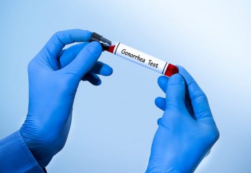 Gonorrhoe diagnostizieren