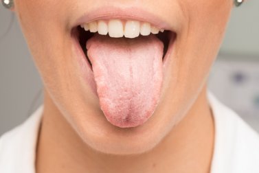 8 Hausmittel gegen weißen Zungenbelag - Besser Gesund Leben