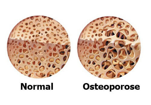 Osteoporose in der Menopause vermeiden Osteoporose in der Menopause vermeiden