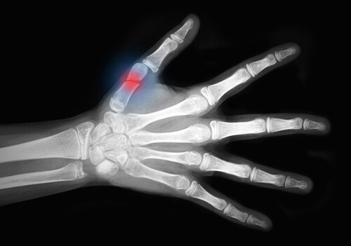 Stürze bei Osteoporose in der Menopause können gefährlich sein.