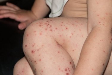 Coxsackievirus: Auswirkungen und Vorsorge