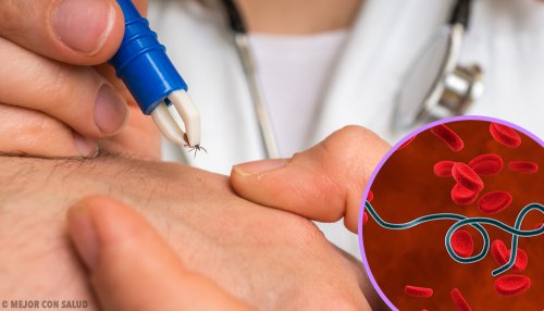Lyme-Borreliose Lyme-Borreliose