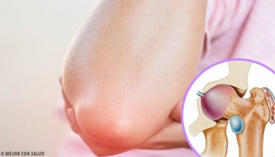 Wissenswertes über Bursitis