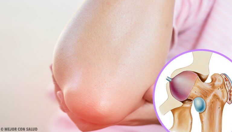 Wissenswertes über Bursitis Wissenswertes über Bursitis
